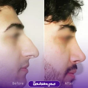 نمونه کار عمل بینی دکتر حمید مزارعی 8