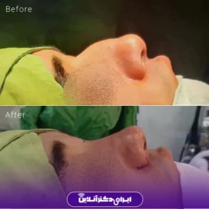 نمونه کار عمل بینی دکتر حسین محمودی 4