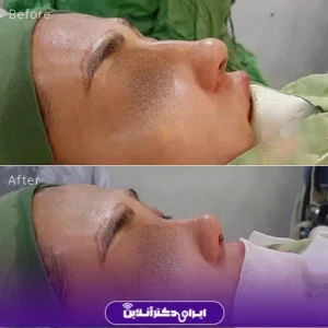 نمونه کار عمل بینی دکتر حسین محمودی 3