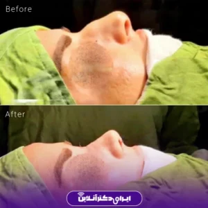 نمونه کار عمل بینی دکتر حسین محمودی 1