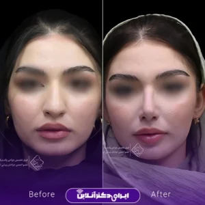 نمونه کار عمل بینی دکتر جلال معتمدی فر 1