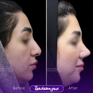 نمونه کار عمل بینی دکتر جلال معتمدی فر 3