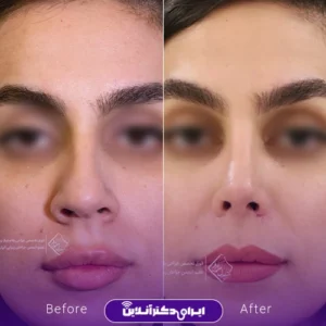 نمونه کار عمل بینی دکتر جلال معتمدی فر 4