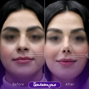 نمونه کار عمل بینی دکتر جلال معتمدی فر 5