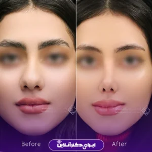 نمونه کار عمل بینی دکتر جلال معتمدی فر 7