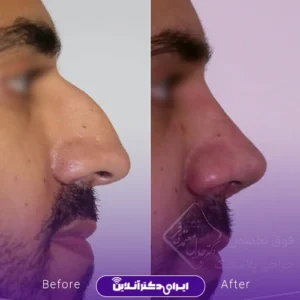 نمونه کار عمل بینی دکتر جلال معتمدی فر 8