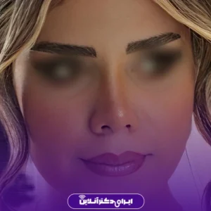 نمونه کار عمل بینی دکتر لاله ترابی 6