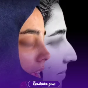 نمونه کار عمل بینی دکتر لاله ترابی 5