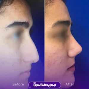 نمونه کار عمل بینی دکتر لاله ترابی 3