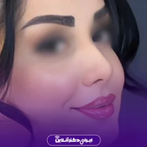 نمونه کار عمل بینی دکتر لاله ترابی 2