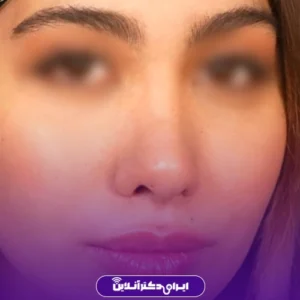 نمونه کار عمل بینی دکتر لیلا ملکی 3