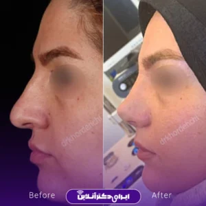 نمونه کار عمل بینی دکتر مهشید خورده چی 2