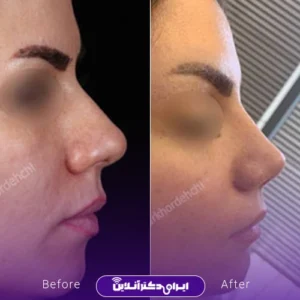 نمونه کار عمل بینی دکتر مهشید خورده چی 3