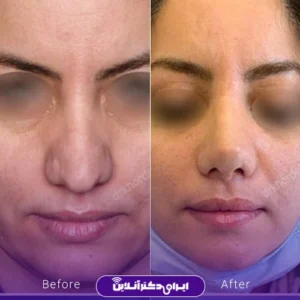 نمونه کار عمل بینی دکتر مهشید خورده چی 4