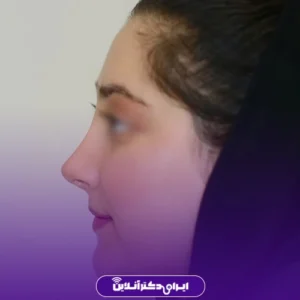 نمونه کار عمل بینی دکتر معصومه نیازی 3