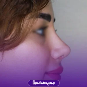نمونه کار عمل بینی دکتر معصومه نیازی 5