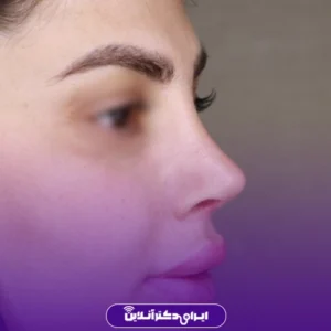 نمونه کار عمل بینی دکتر معصومه نیازی 6