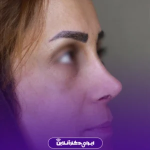 نمونه کار عمل بینی دکتر معصومه نیازی 7
