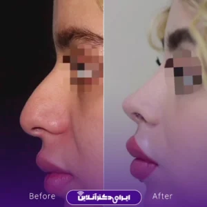 نمونه کار عمل بینی دکتر معصومه نیازی 8