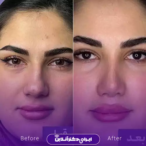 بهترین جراح بینی گوشتی در مشهد سال 1405 51 نمونه کار عمل بینی گوشتی دکتر محمد عابدی 1