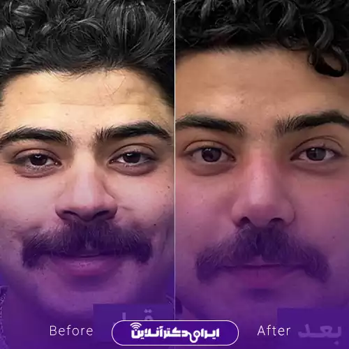 بهترین جراح بینی گوشتی در مشهد سال 1405 49 نمونه کار عمل بینی گوشتی دکتر محمد عابدی 3