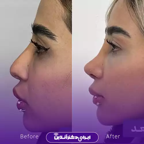 بهترین جراح بینی گوشتی در مشهد سال 1405 48 نمونه کار عمل بینی گوشتی دکتر محمد عابدی 4