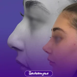 نمونه کار عمل بینی دکتر محمد عابدی 6