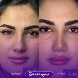 نمونه کار عمل بینی گوشتی دکتر محمد عابدی 1