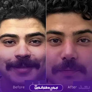 نمونه کار عمل بینی گوشتی دکتر محمد عابدی 3