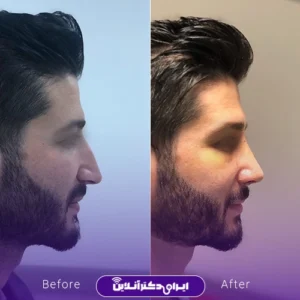 نمونه کار عمل بینی دکتر محمدرضا سلیمی 1