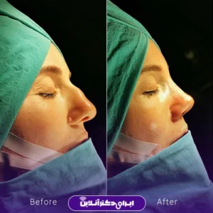 نمونه کار عمل بینی دکتر محمدرضا سلیمی 8