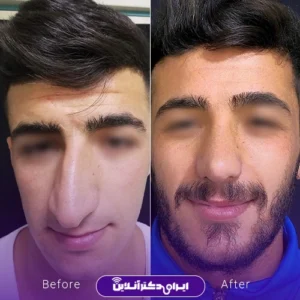 نمونه کار عمل بینی دکتر محمدرضا سلیمی 6