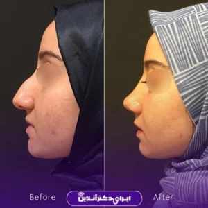 نمونه کار عمل بینی دکتر محمدرضا سلیمی 7