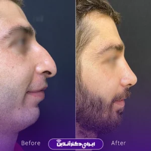 نمونه کار عمل بینی دکتر محمدرضا سلیمی 4