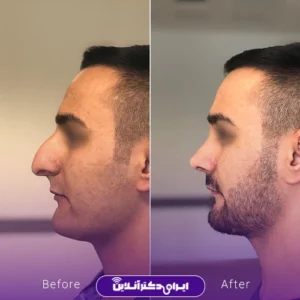 نمونه کار عمل بینی دکتر محمدرضا سلیمی 2