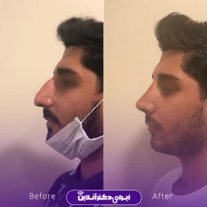 نمونه کار عمل بینی دکتر محمدرضا سلیمی 3