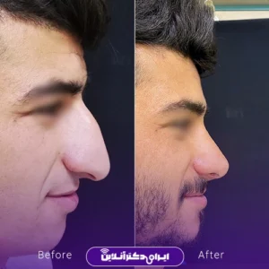 نمونه کار عمل بینی دکتر محمدرضا سلیمی 5