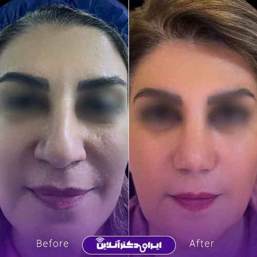 بهترین جراح بینی در زاهدان + راهنمای جامع عمل بینی و هزینه 1405 137 نمونه کار جراحی بینی دکتر محمد زارع در زاهدان 2