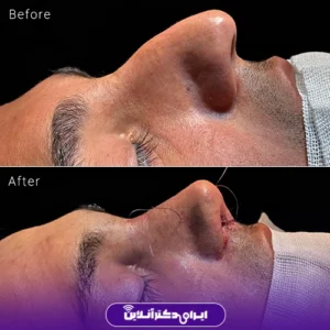 نمونه کار عمل بینی دکتر پویا علیزاده 1