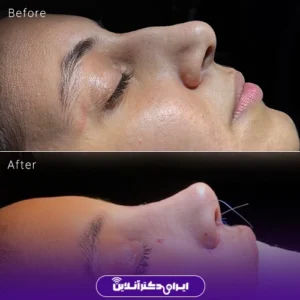 نمونه کار عمل بینی دکتر پویا علیزاده 2