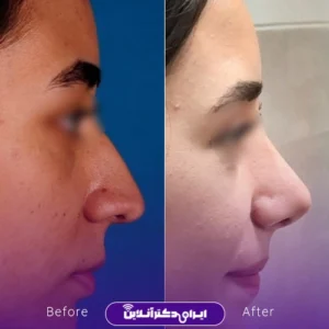 نمونه کار عمل بینی دکتر پویا علیزاده 3
