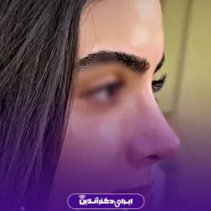 نمونه کار عمل بینی دکتر پویا علیزاده 4