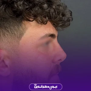 نمونه کار عمل بینی دکتر پویا علیزاده 6
