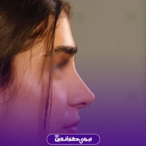 نمونه کار عمل بینی دکتر پویا علیزاده 7
