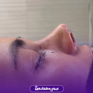 نمونه کار عمل بینی دکتر پویا علیزاده 8