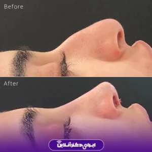 نمونه کار عمل بینی دکتر سمانه زند 2