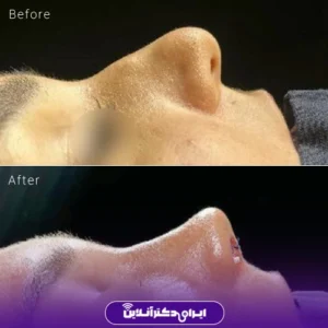 نمونه کار عمل بینی دکتر سمانه زند 3