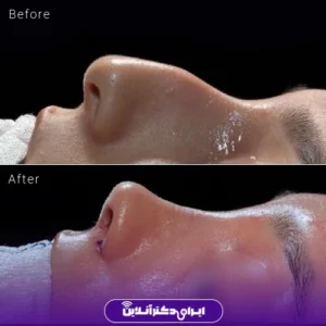 نمونه کار عمل بینی دکتر سمانه زند 4
