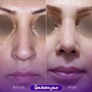 نمونه کار عمل بینی دکتر سمانه زند 5