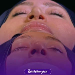 نمونه کار عمل بینی دکتر شبنم حاجی علی پور 1
